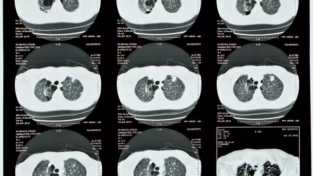 lungescanning