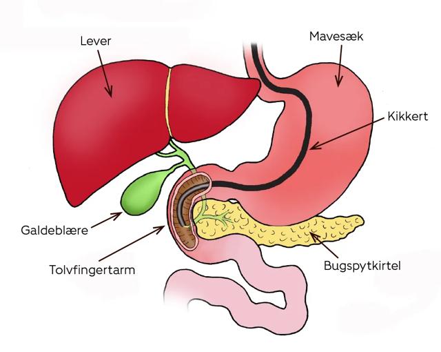 Tegningen viser en ERCP-undersøgelse