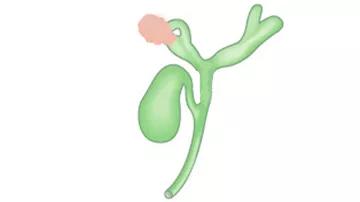 Illustration af kræftknude i højre side af galdegangen, som går ind i leveren
