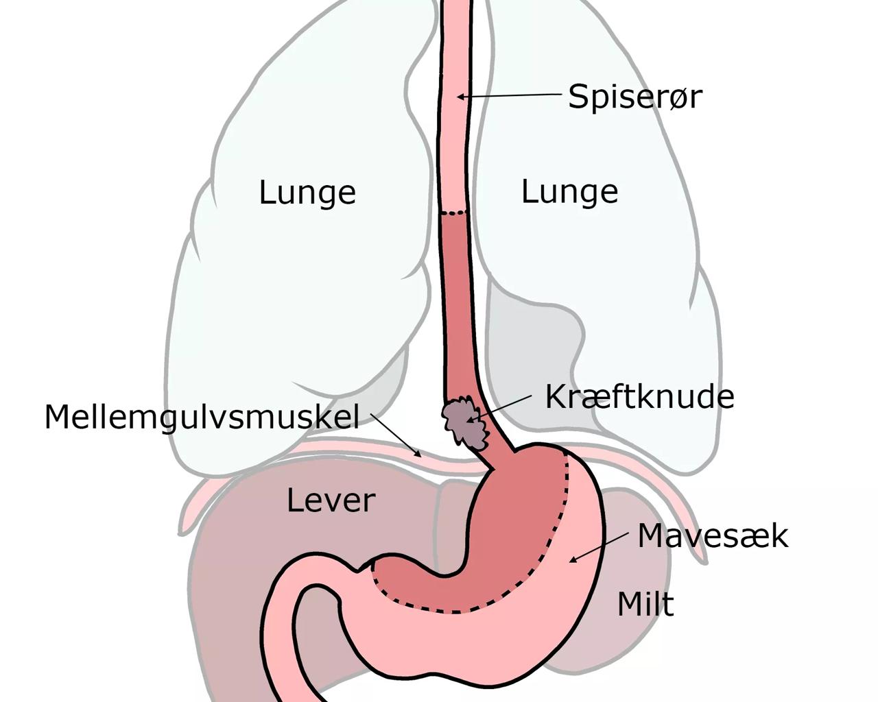 Illustration viser spiserør og mavesæk før operation.