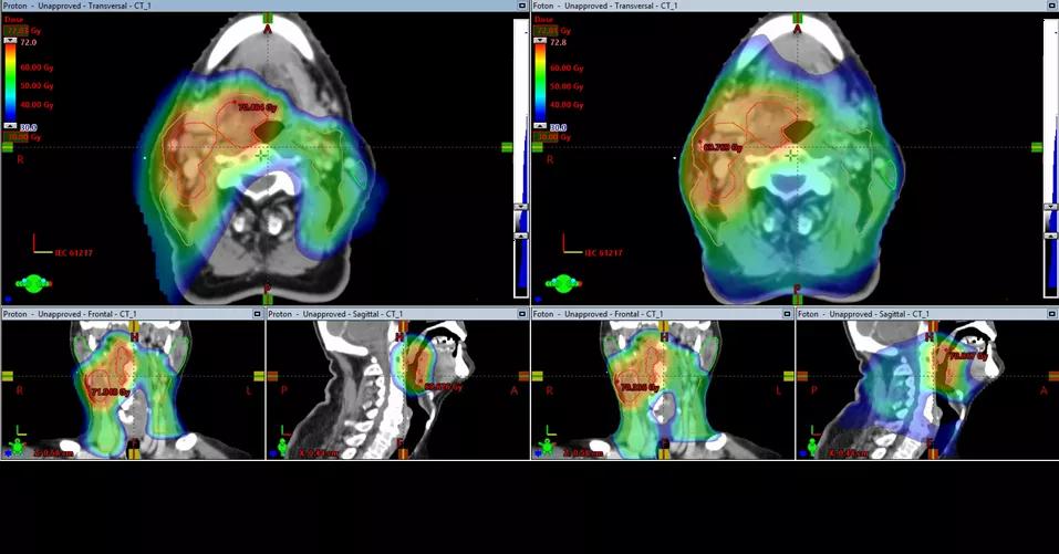 To scanningsbilleder af patient med kræft i mandel og tungerod.