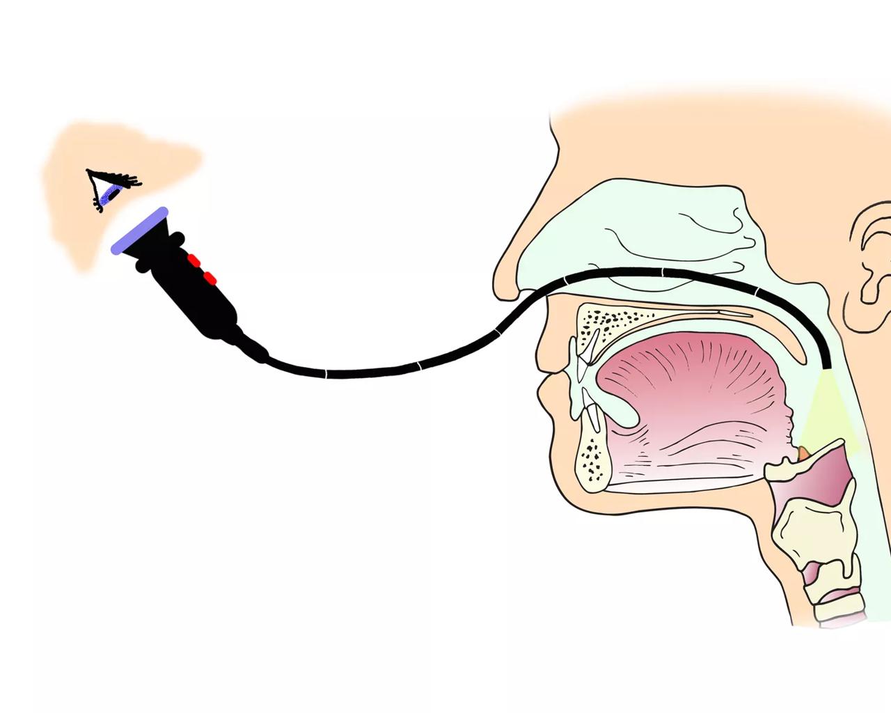 Illustration, der viser den bøjelige kikkert og svælget i tværsnit