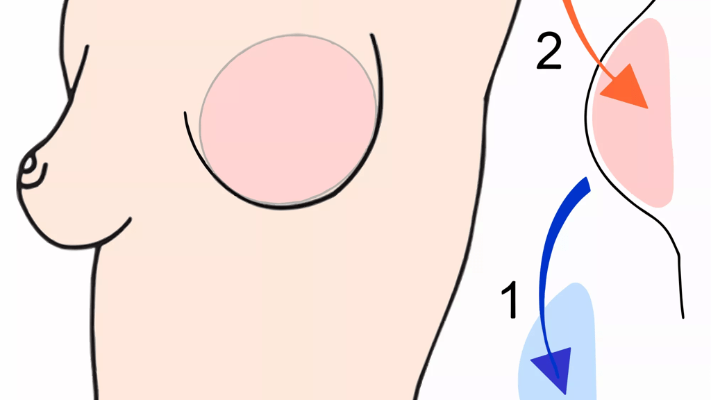 Illustrationen viser er et udvidet bryst, hvor ekspanderen er udskiftet med et blivende implantat.