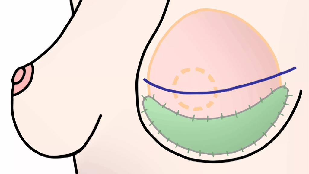 Illustration viser, hvor implantat og støttevæv placeres i det rekonstruerede bryst. 
