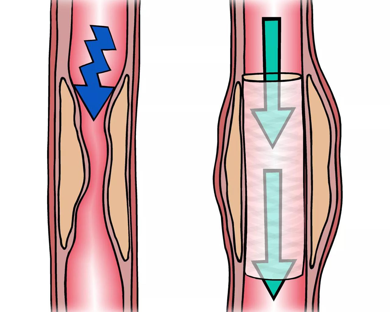 Illustration af en stent