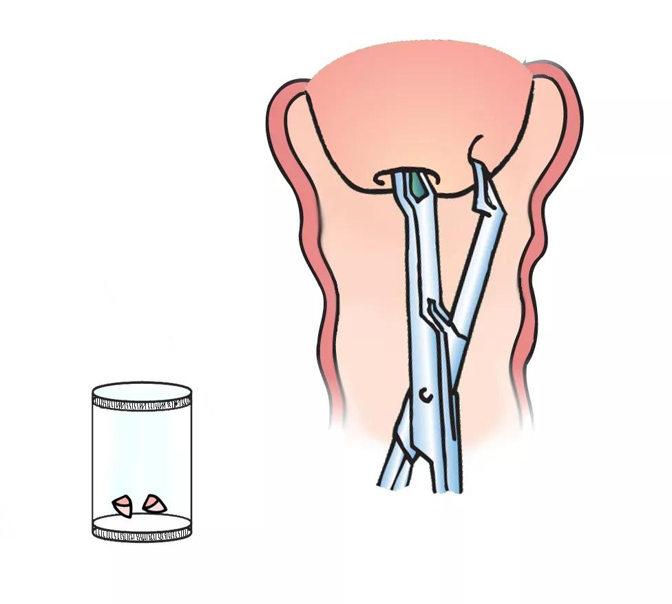 En tang anvendes til at tage vævsprøve af livmoderhalsen.