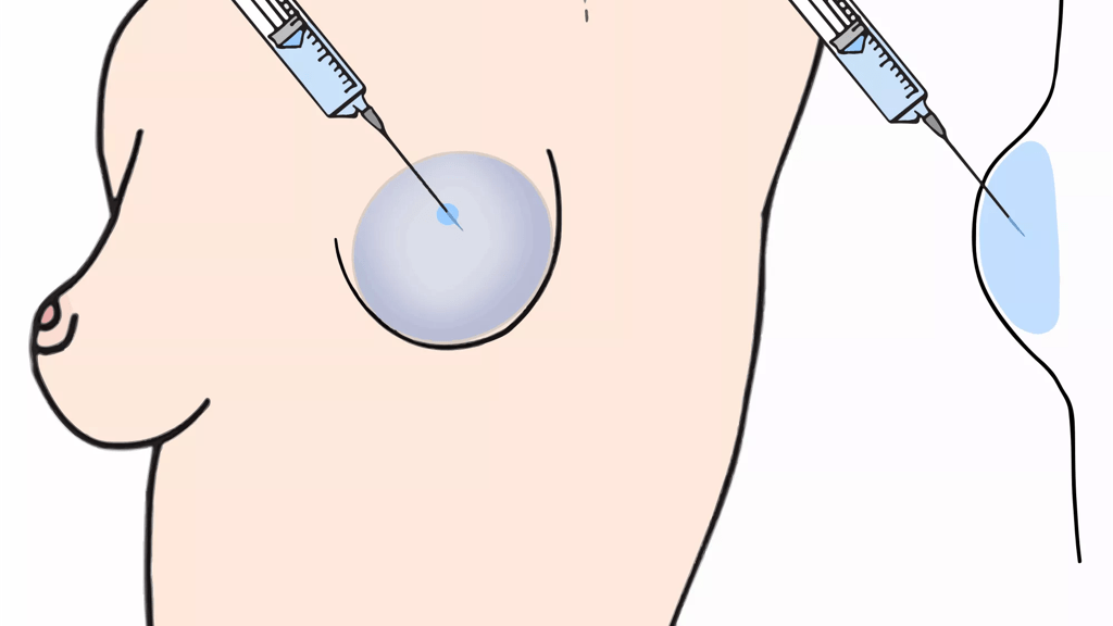 Illustration af et kvindebryst med et implantat i, der fyldes med saltvand via en kanyle