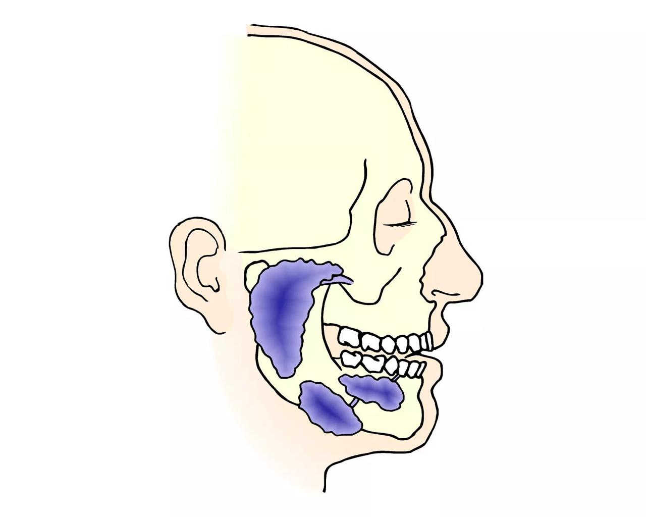 Illustration af hoved med spytkirtlerne markeret med blåt.