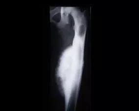 Foto af ondartet knoglesarkom på en lårbensknogle