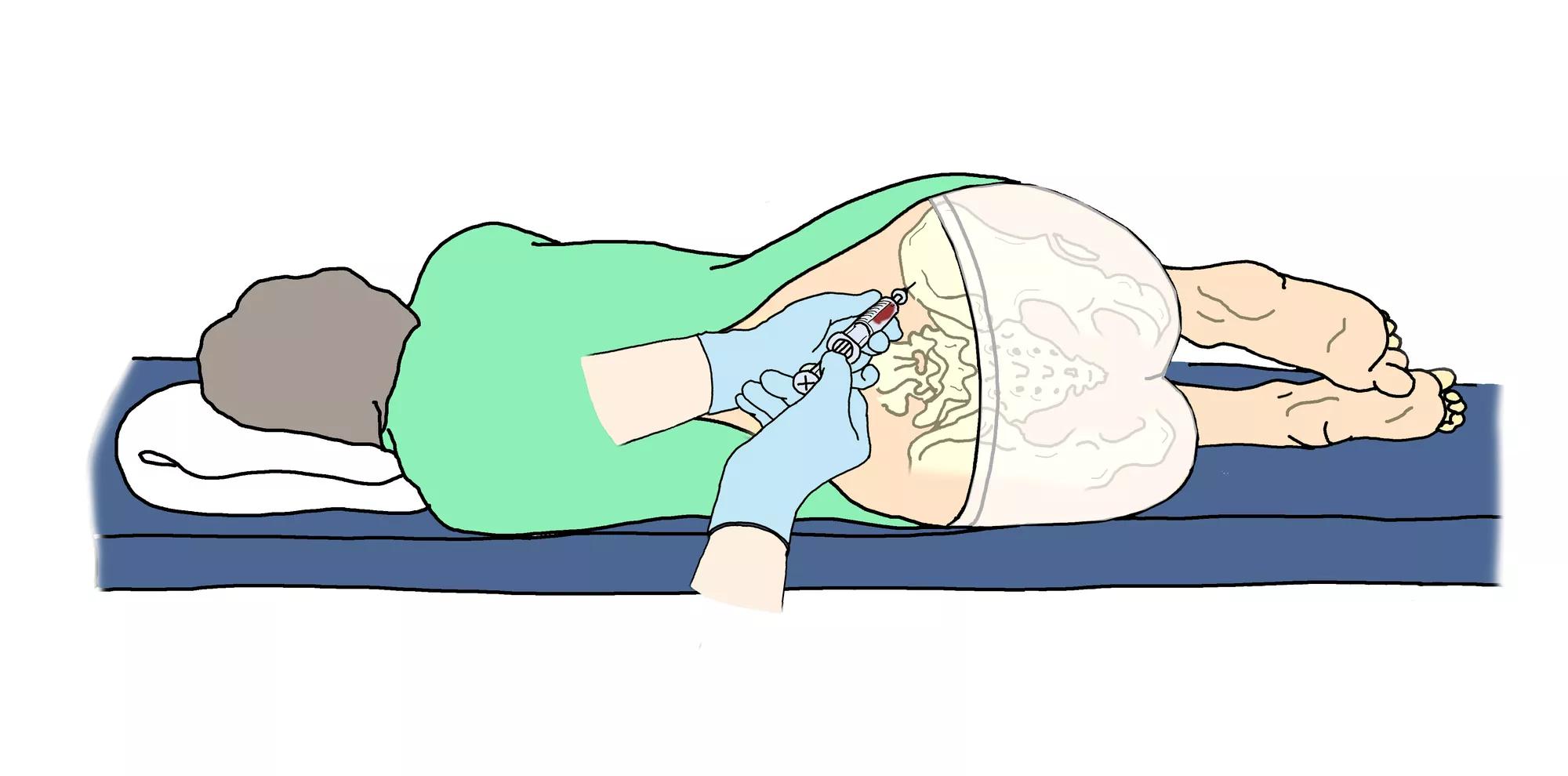 Illustration af patient, som ligger på siden og får taget en knoglemarvsprøve