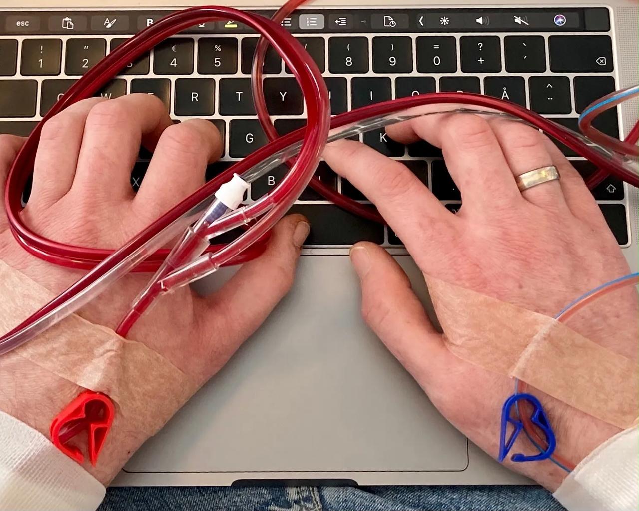 Egil får ECP-behandling, hvor blodet føres ud af kroppen, behandles med lys og sendes tilbage igen. Behandlingen hjælper med at regulere immunforsvaret efter hans knoglemarvstransplantation.