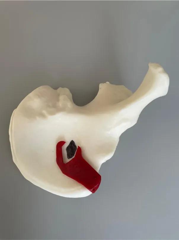 Knoglesarkom 3D print