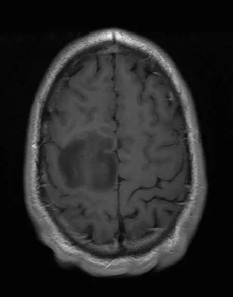 MR-scanningsbillede af hjernen