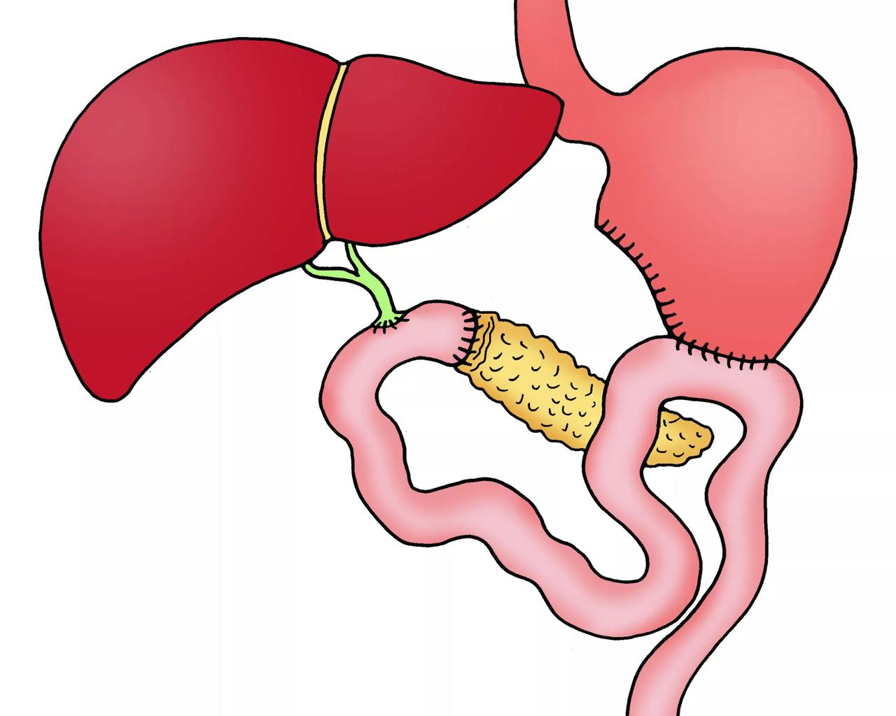 Illustration, der viser organerne efter operation
