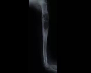 Foto af godartet cyste i en overarmsknogle