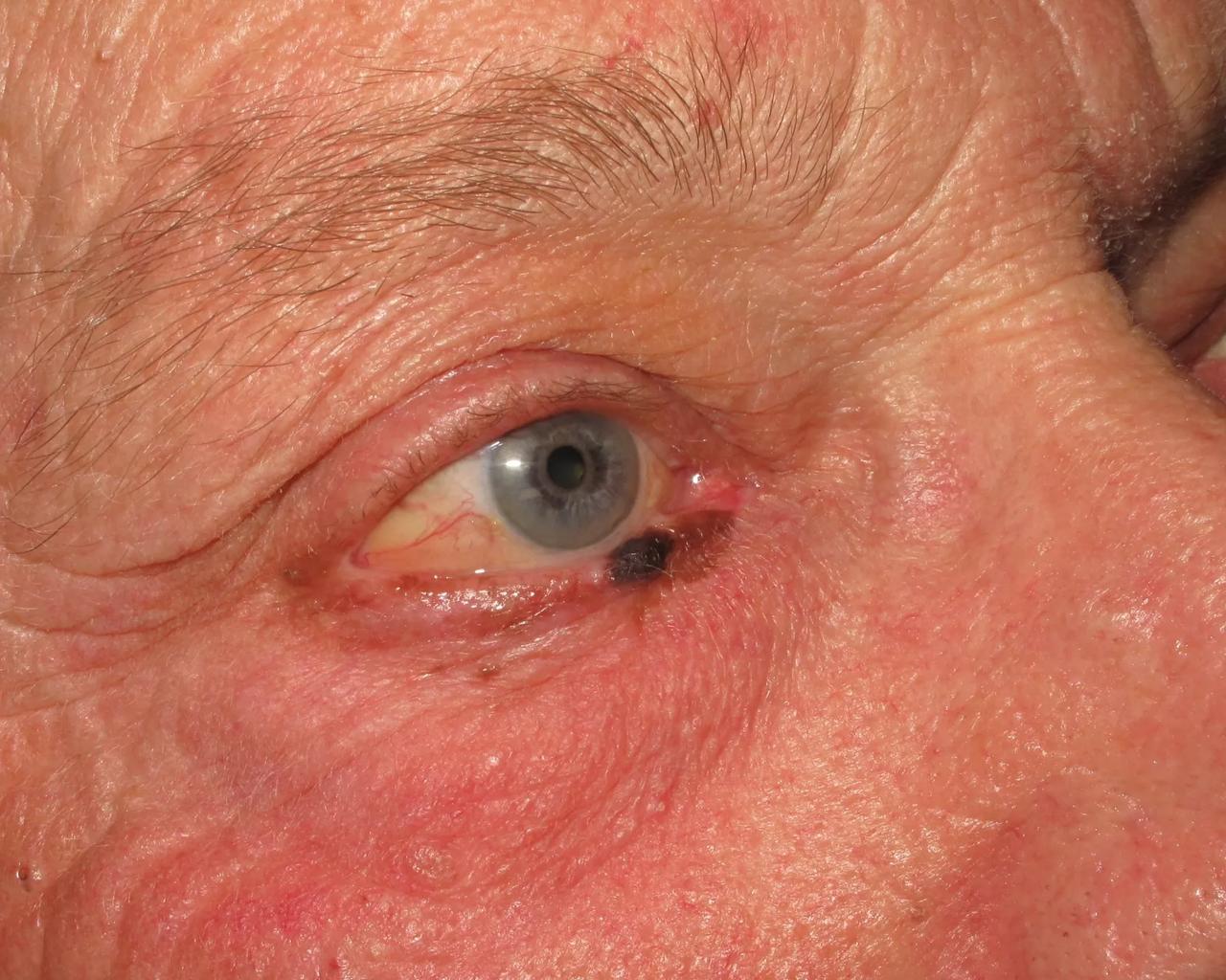 Modermærkekræft i det nedre højre øjenlåg