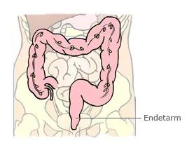 Illustration af tyktarm og endetarm