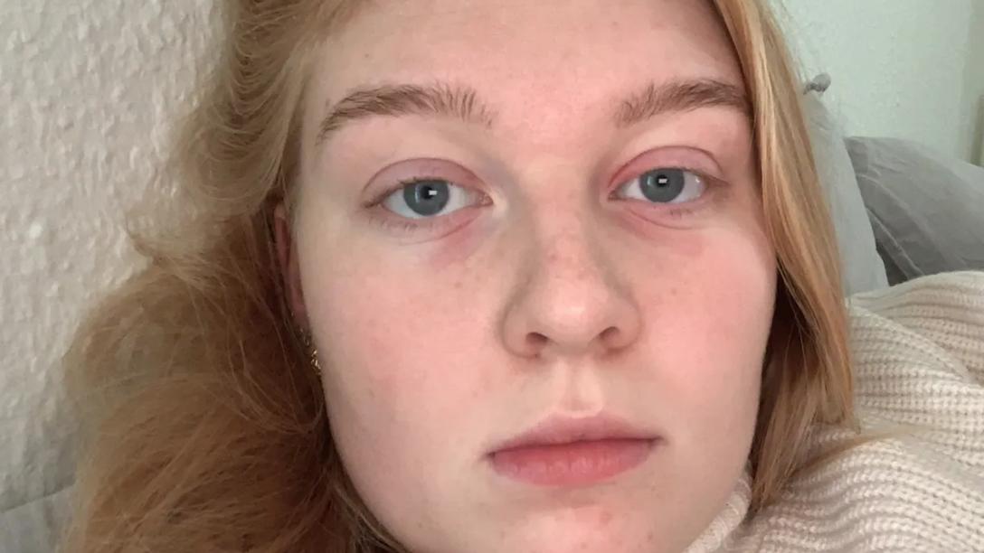 Julie Sole var 21 år og sygeplejerskestuderende, da hun fik diagnosen Hodgkin Lymfom i stadie 2B. Hun oplevede i sit forløb, at hun måtte kæmpe alt for meget for at blive taget alvorligt, fordi hun er ung. Privatfoto.