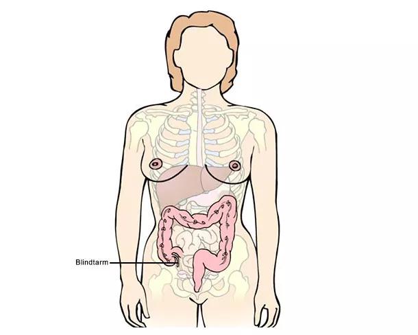 Illustration af en kvindekrop, hvor indre organer og særligt tyktarm og blindtarm er fremhævet