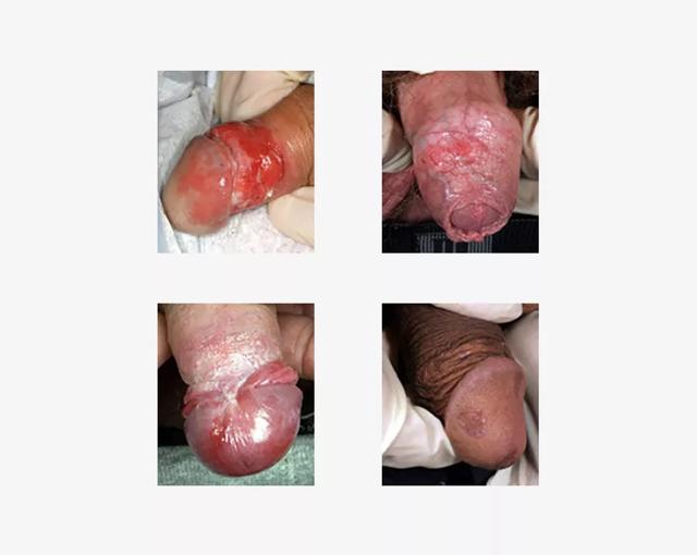 Billederne viser forstadier til peniskræft med blandet andet sår på skaft og penishoved. 
