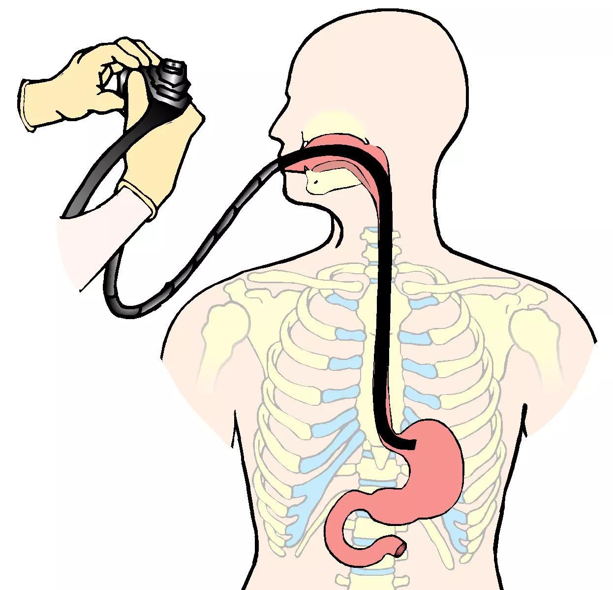 Illustration af en gastroskopisk undersøgelse