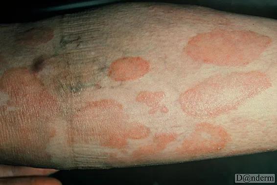 Fotos af mycosis fungoides pletter, der kan udvikle sig til knuder i huden. 