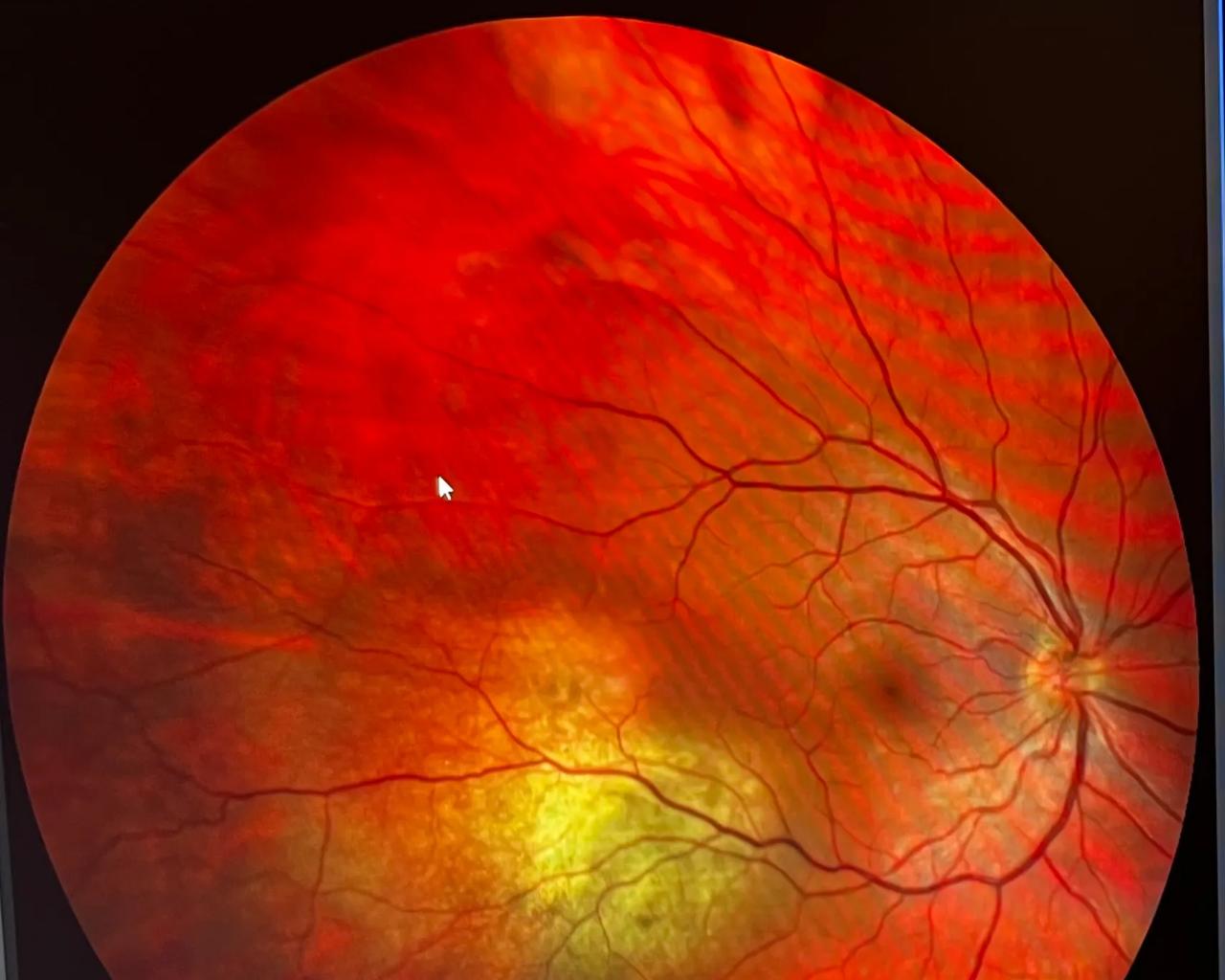 billede af øje med kræfttumor i årehinde