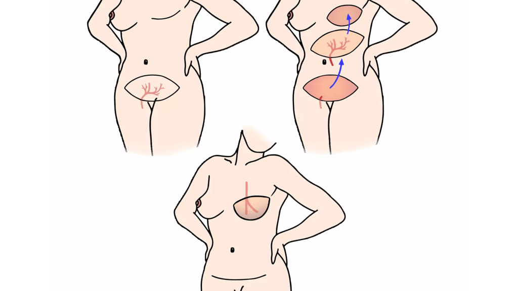 Illustration viser udsnit af tre kvindekroppe og hvorfra DIEP-lapperne bliver flyttet fra.