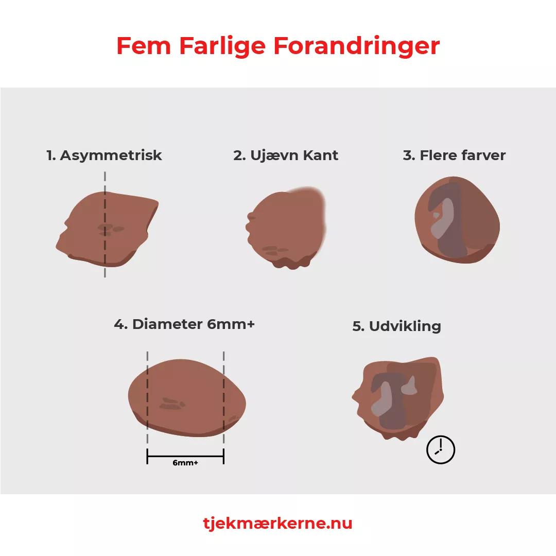 Fem farlige forandringer. Hold øje med modermærker