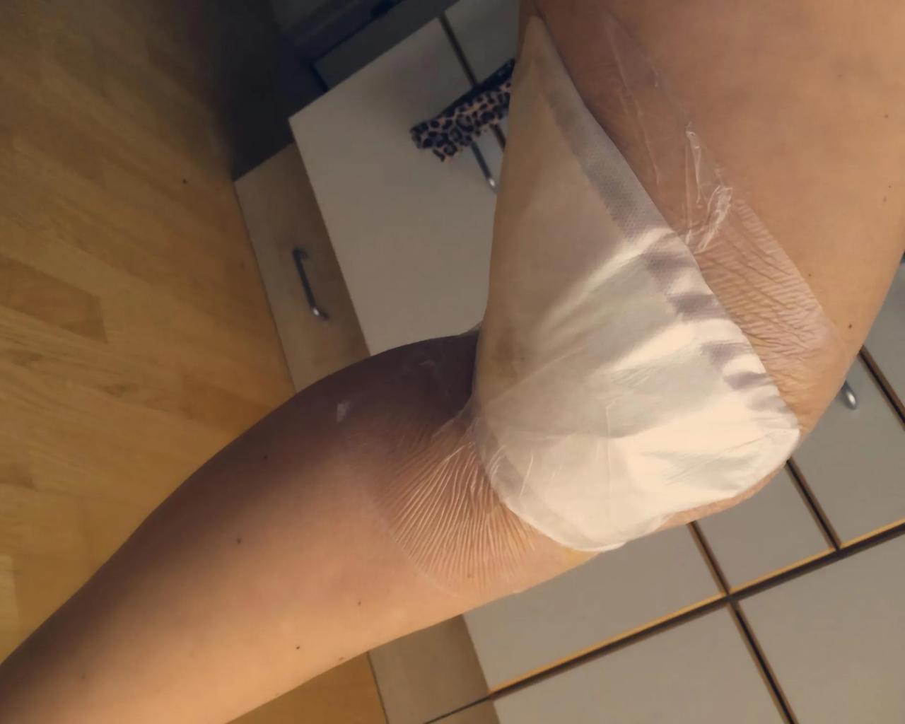Billede af Mettes ben, der er bundet ind efter operation