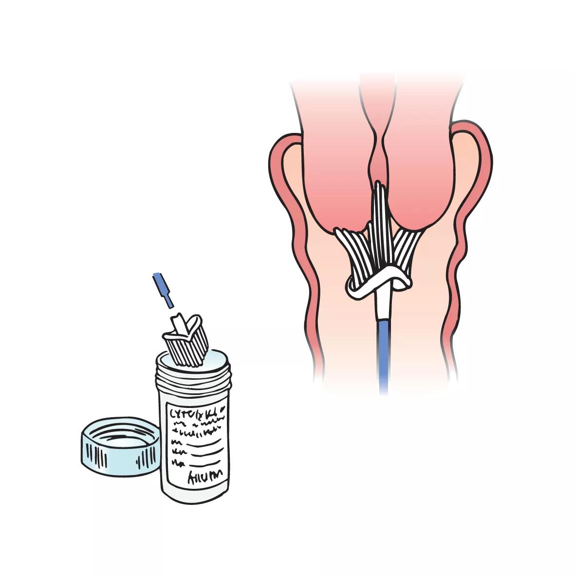 Illustration af børste som bruges til at foretage celleskrab af livmoderhalsen.