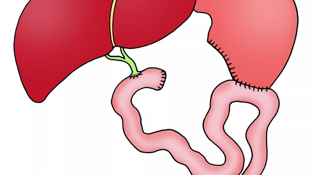 Illustration der viser kræften der sidder i bugspytkirtlens midte - Efter operation.