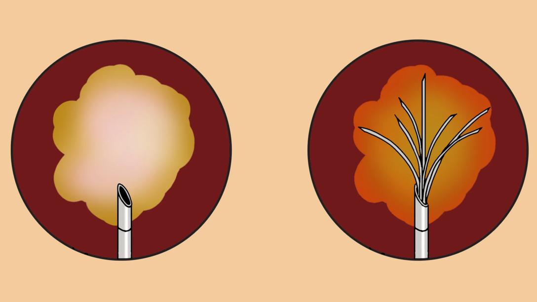 Illustration af Radiofrekvensbehandling 