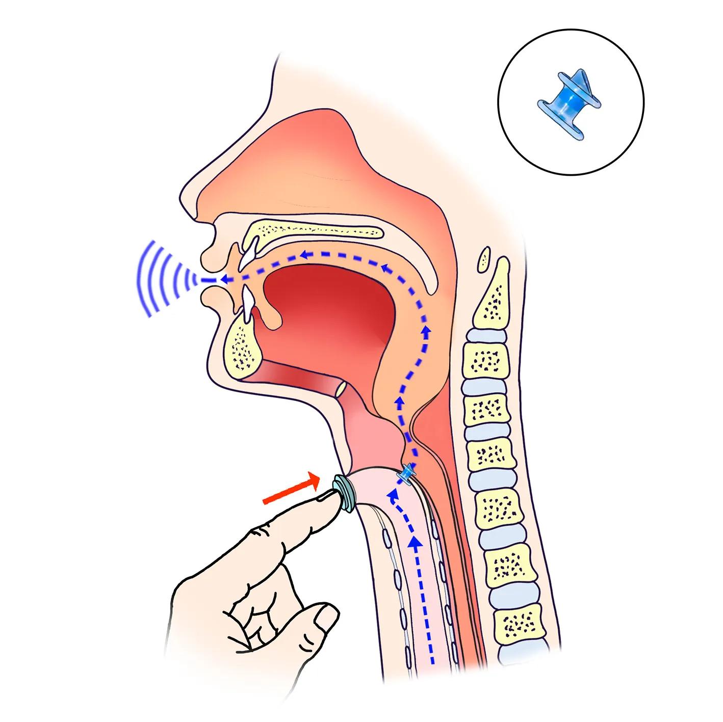 Illustration der viser halsen efter fjernelse af struben og med en taleventil indsat.