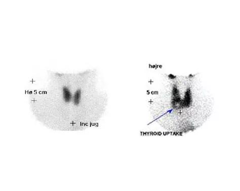 Billedet viser en skintigrafi af en normal og unormal udseende skjoldbruskkirtel
