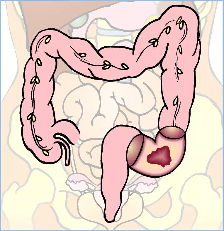 Tyktarm med kræftknude i sigmoideum