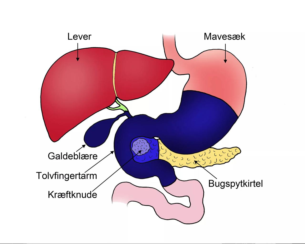 Illustration før Whipples operation