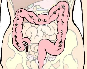 Tegning af tyktarmen