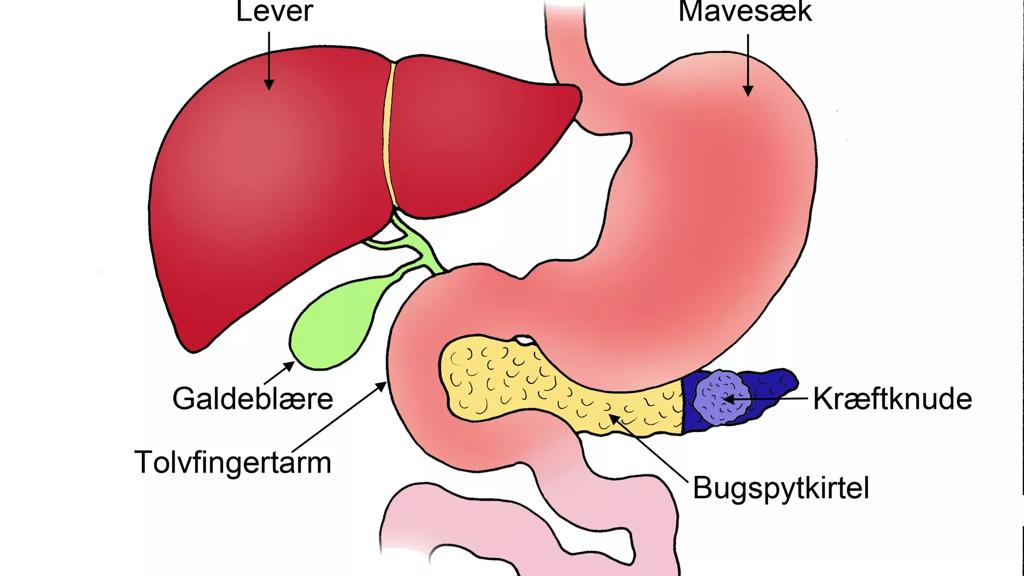 Illustration der viser Kræften der sidder i bugspytkirtlens hale (cauda) - Før operation