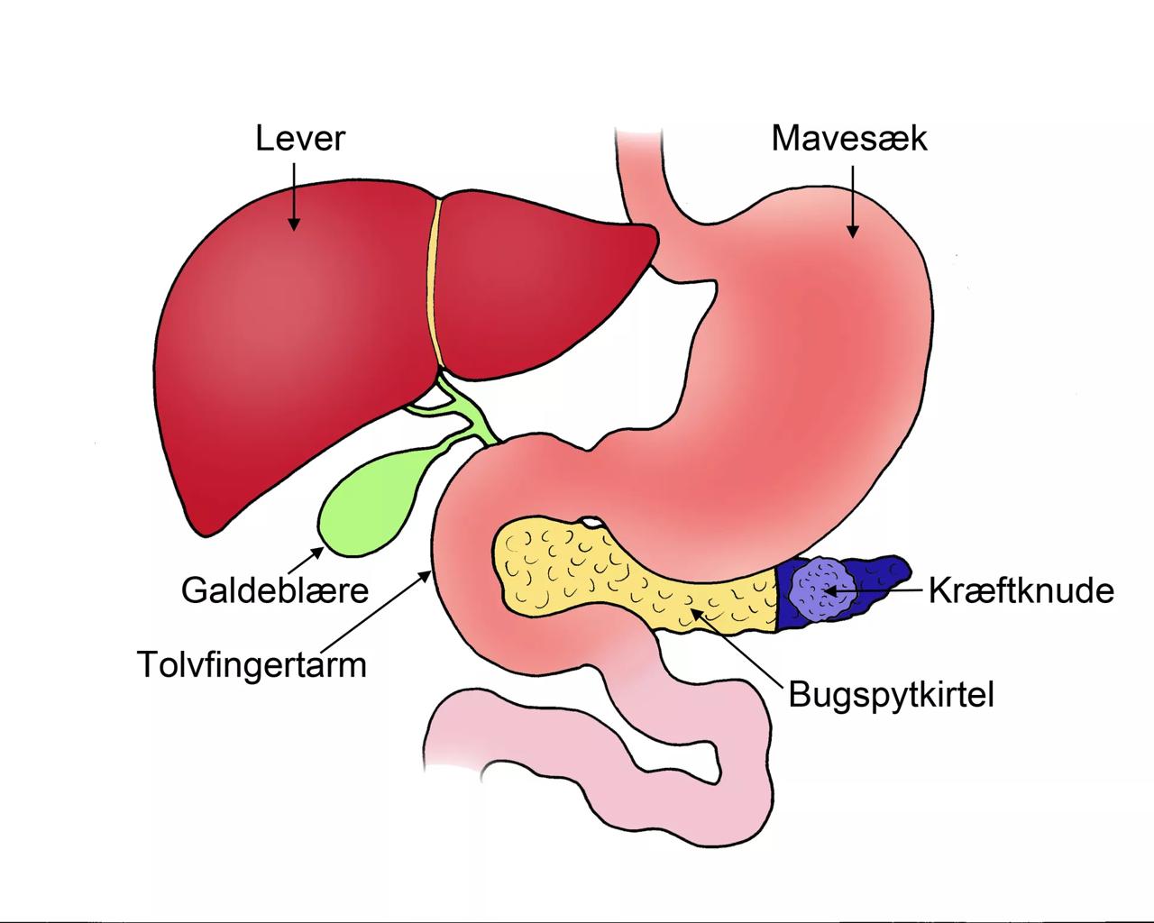 Kræftknuden sidder i bugspytkirtlens hale