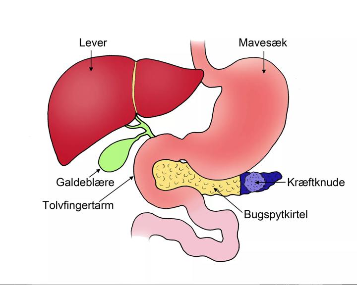 Illustration der viser Kræften der sidder i bugspytkirtlens hale (cauda) - Før operation