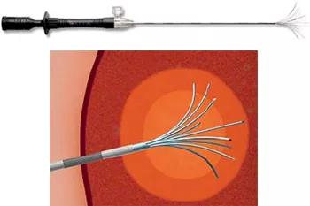 Illustrationen viser, hvordan der ud af nålen skydes flere mindre nåle-elektroder ind i knuden.