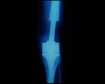 Foto af en rekonstruktion af et knæled med en indvendig knæprotese