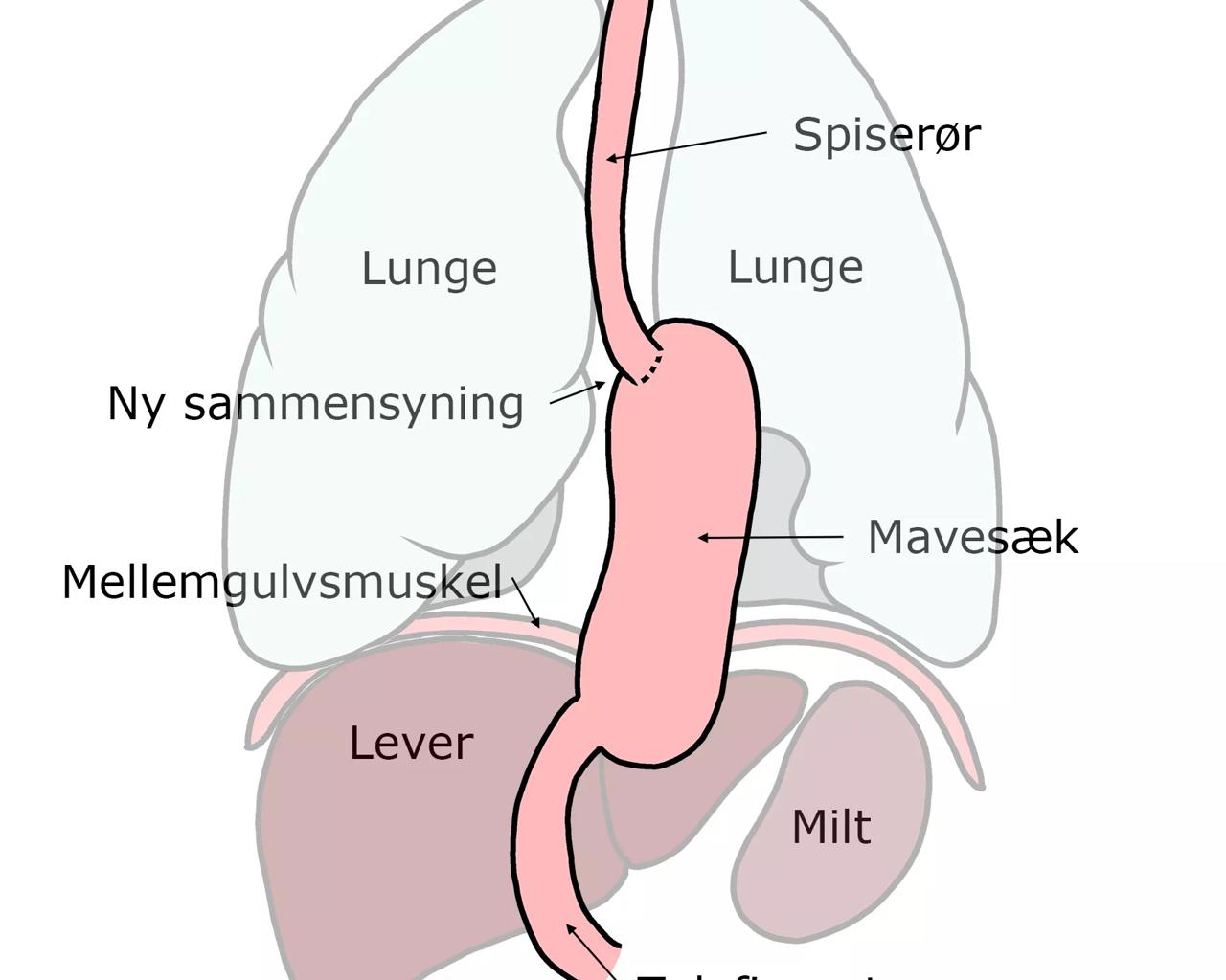 Illustration viser spiserør og mavesæk efter operation