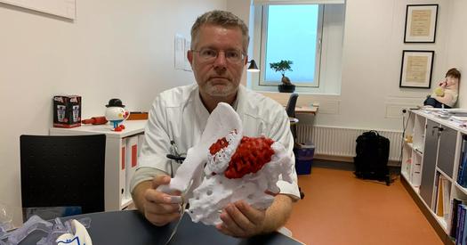 3D-printede knogler giver bedre sarkom-operationer
