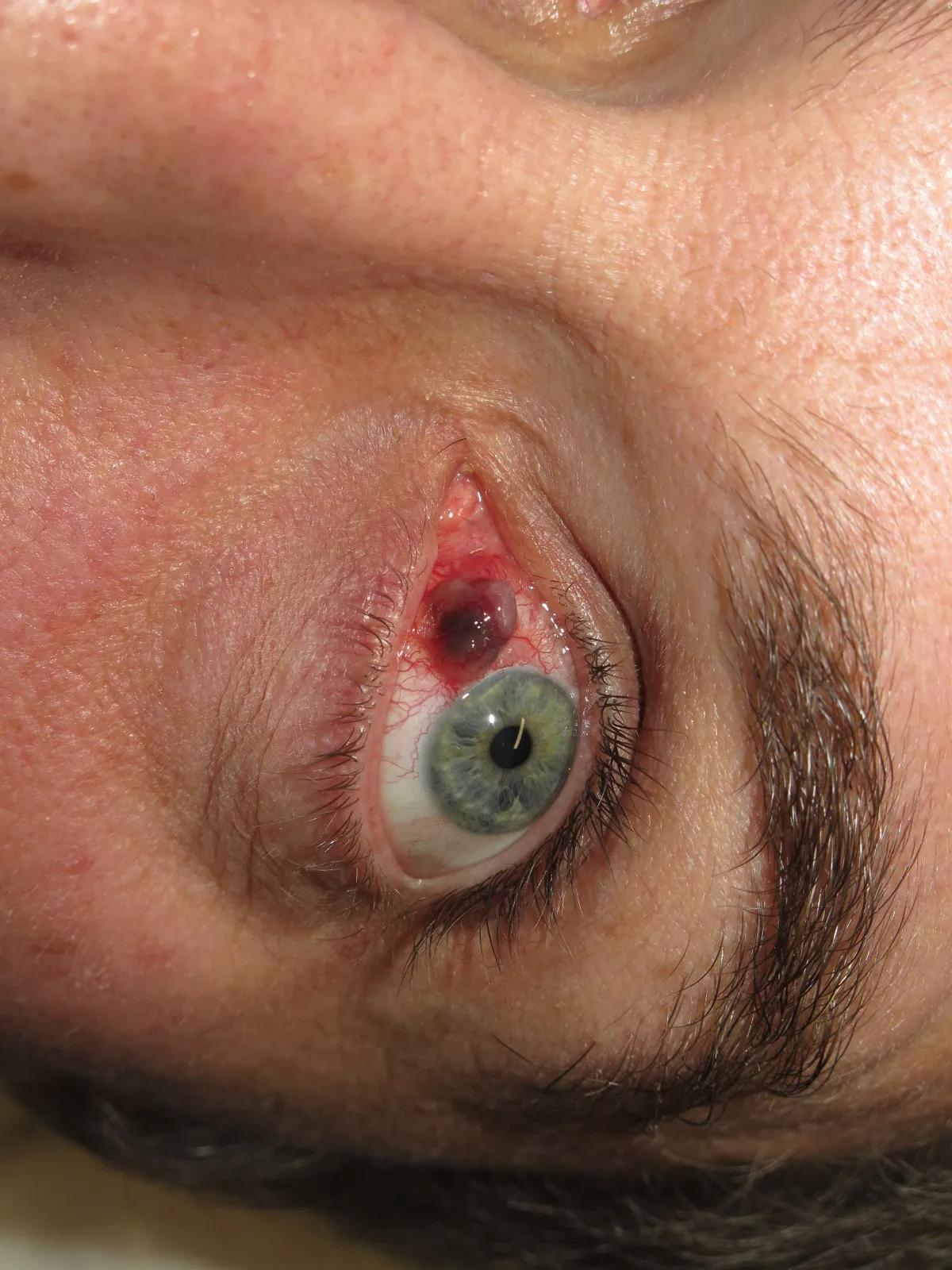 Modermærkekræft i slimhinden på øjets forside