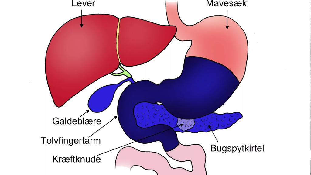Illustration der viser at kræften sidder i bugspytkirtlens midte - Før operation.