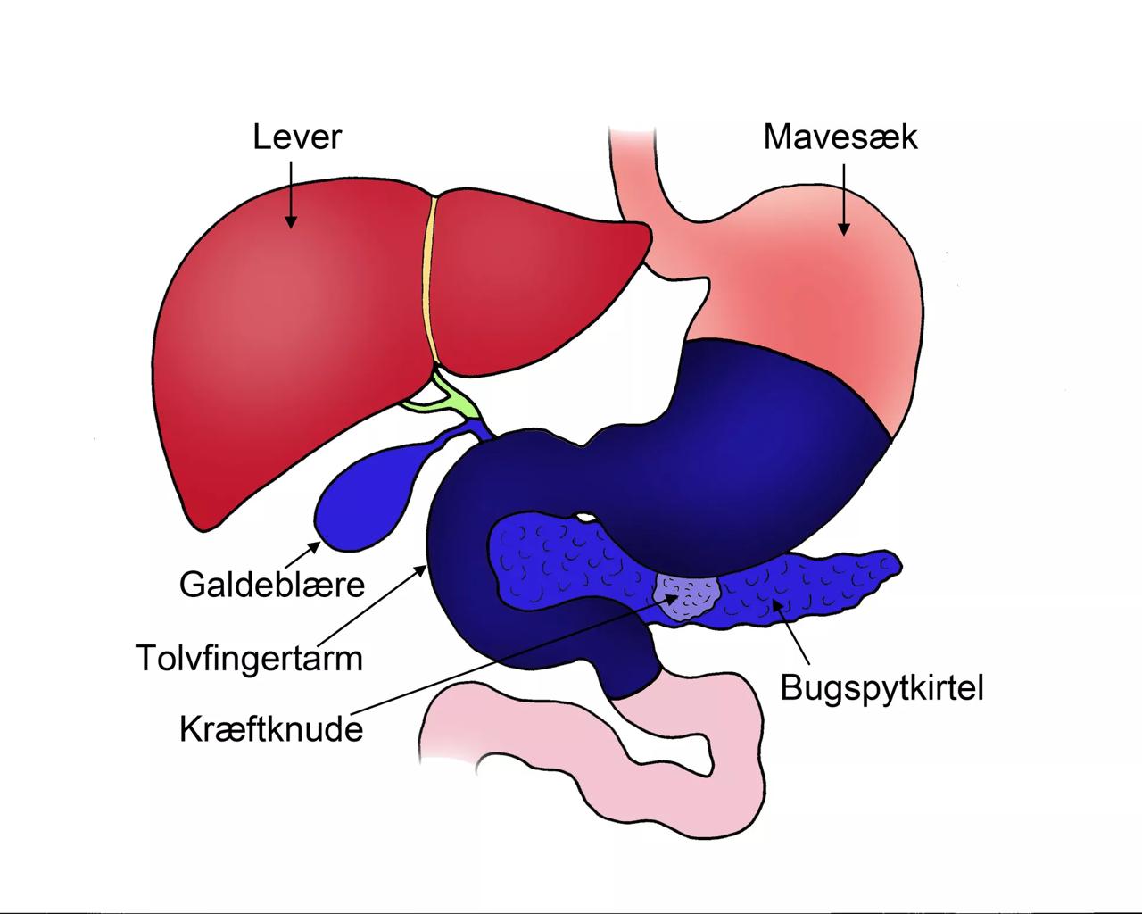 Kræftknuden sidder i midten af bugspytkirtlen