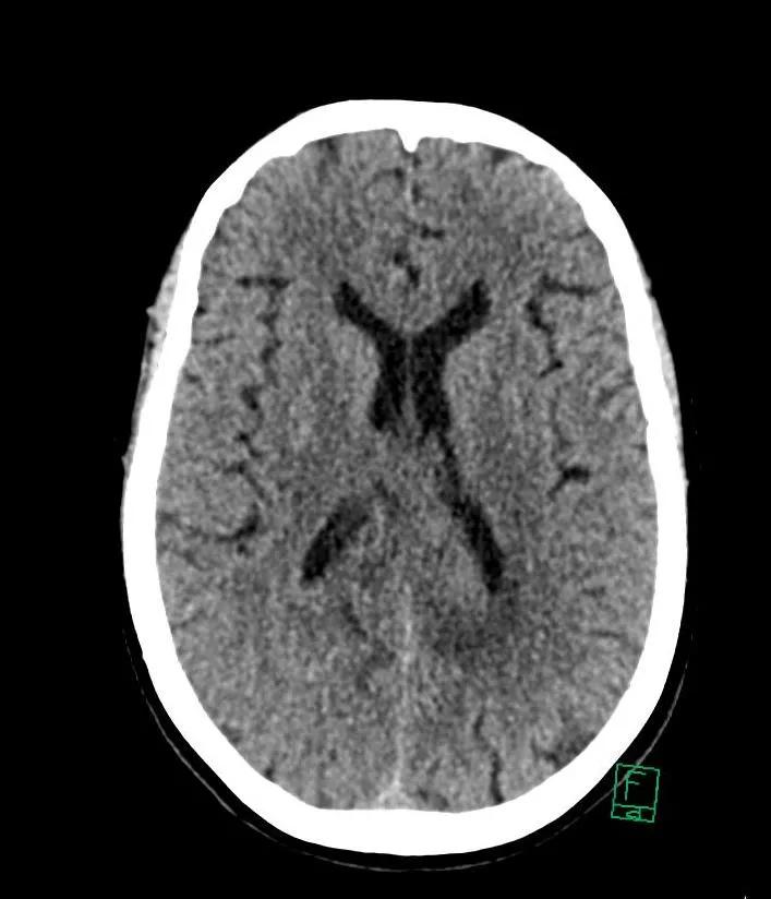 CT-scanningsbillede af hjerne uden kontrastvæske