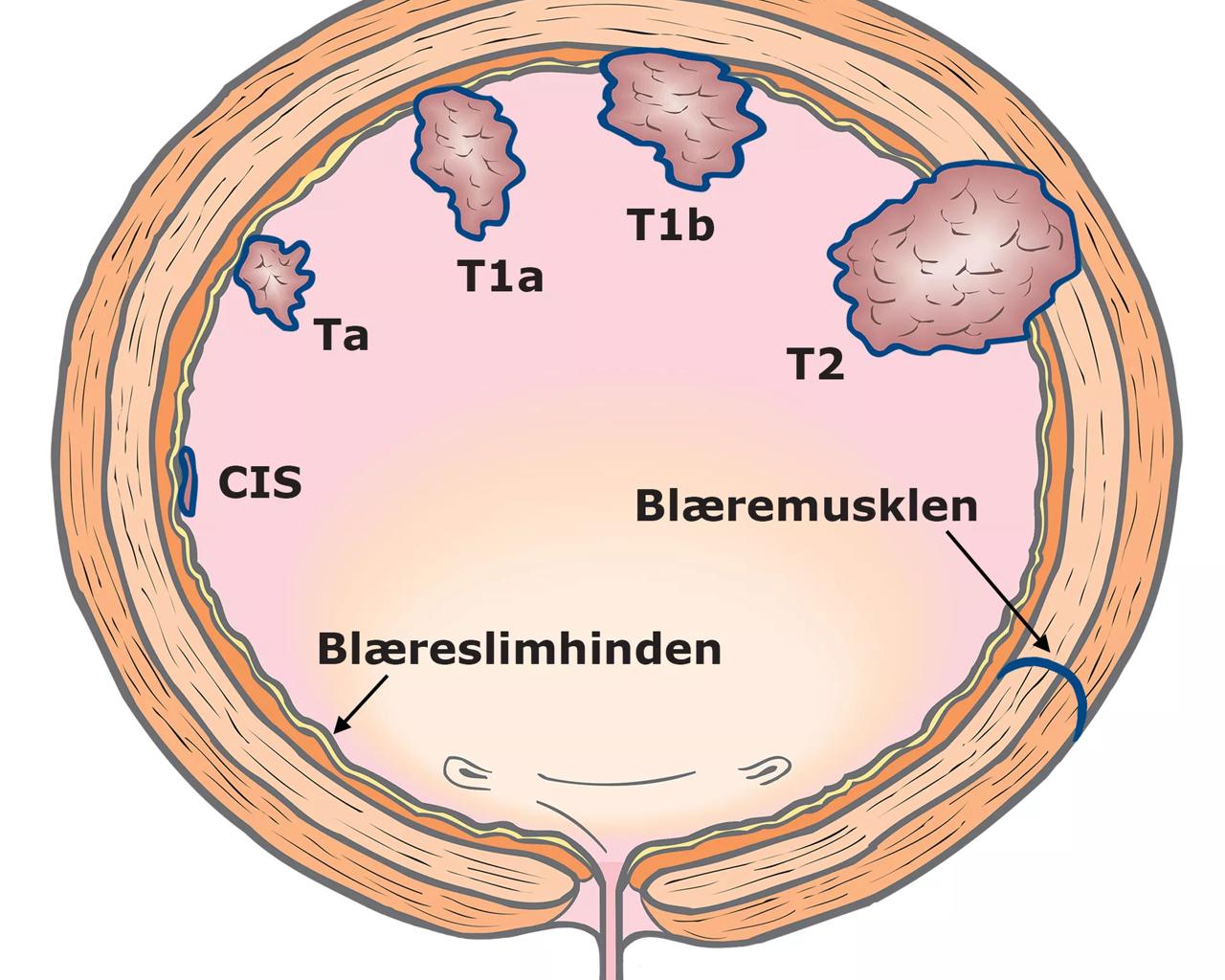 Tværsnit af blæren. Figuren viser forskellige stadier af blærekræft.